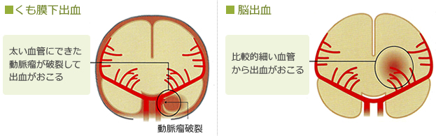 くも膜下出血：太い血管にできた動脈瘤が破裂して出血がおこる、脳出血：比較的細い血管から出血がおこる